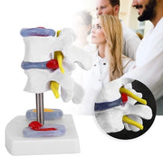 Modello anatomico della colonna vertebrale lombare - Dischi intervertebrali - Nervi spinali patologici - Materiale didattico - Base solida