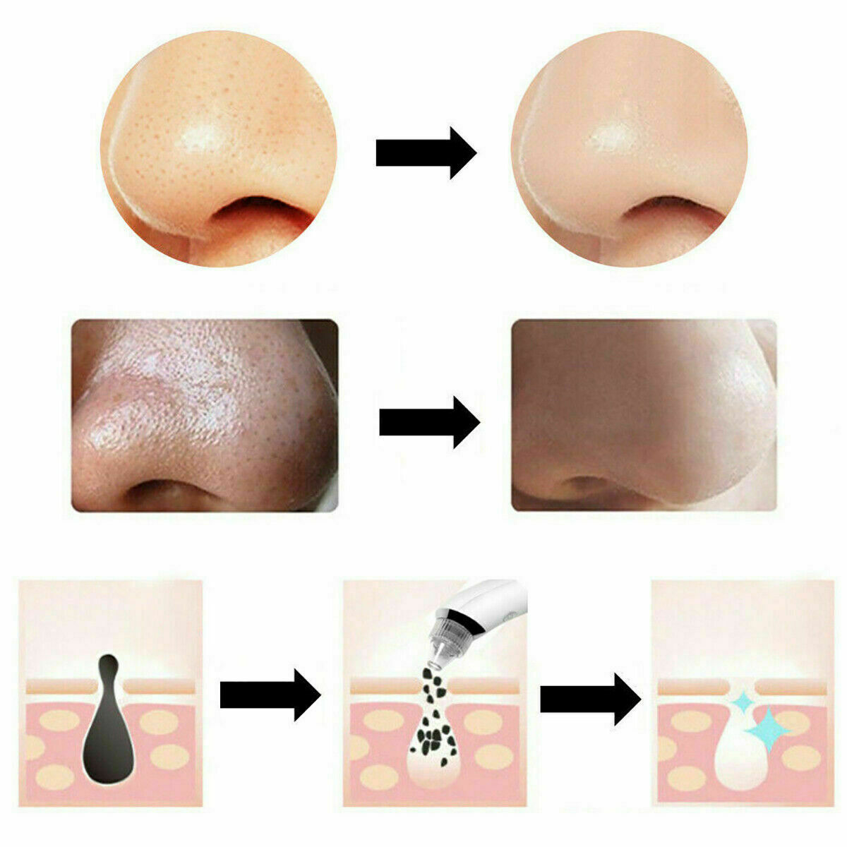 ASPIRA ELIMINA RIMUOVI PUNTI NERI PULIZIA VISO BRUFOLI A BATTERIE PORI NASALI