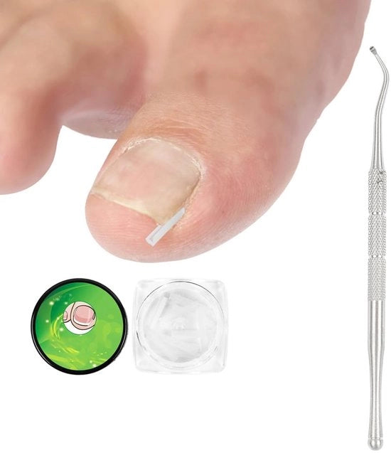 Correttore per unghie 50 pezzi - Lifter unghie senza dolore - Kit per ingrossamento unghie - Trattamento scientifico - Riduzione del dolore e della rossura - Correzione unghie