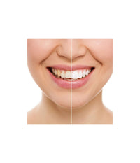 Dispositivo Professionale Sbiancante A Led Denti Dental White Rx Sorriso Super         