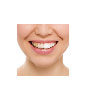 Dispositivo Professionale Sbiancante A Led Denti Dental White Rx Sorriso Super         