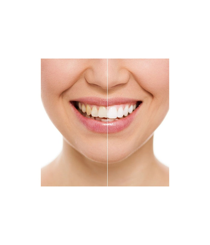 Dispositivo Professionale Sbiancante A Led Denti Dental White Rx Sorriso Super         